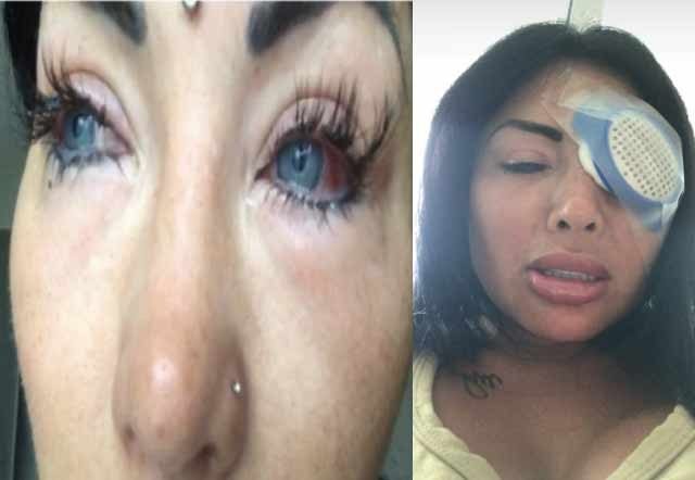 Eye Color Change surgery gone bad as Model is left