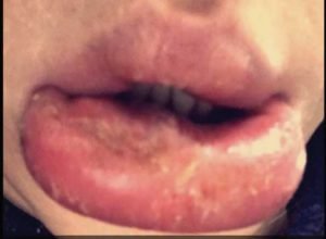 Lip injection gone wrong