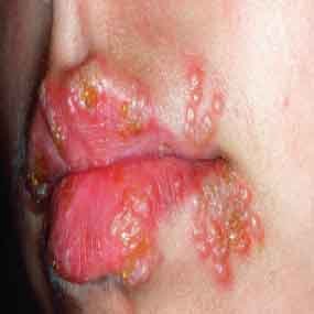 herpes simplex