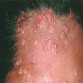 Molluscum contagiosum