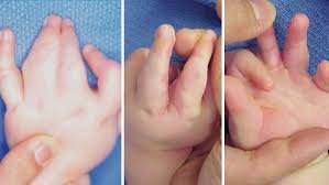 Webbed Fingers or Toes