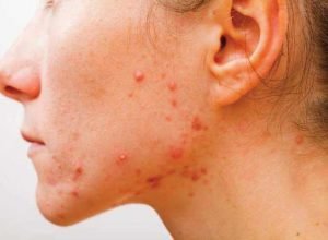 31 Foods To Avoid that Causes Pimples also known as Acne