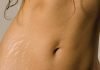 12 Stretch Marks Facts And Stretch Marks Removal
