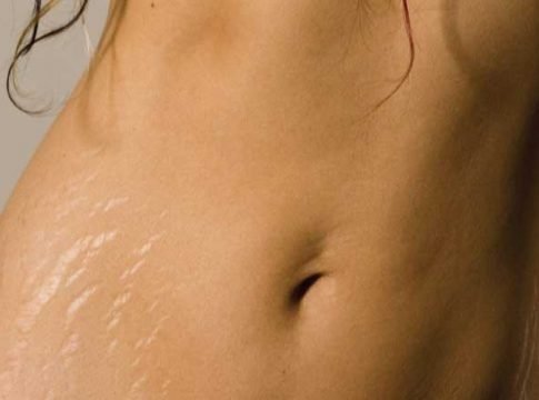 12 Stretch Marks Facts And Stretch Marks Removal